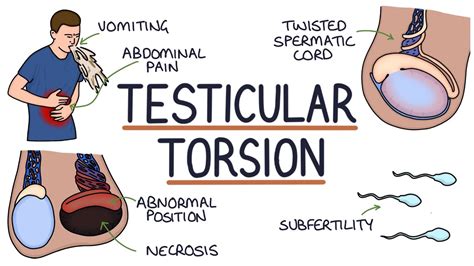 how to test yourself for testicular torsion|early signs of testicular torsion.